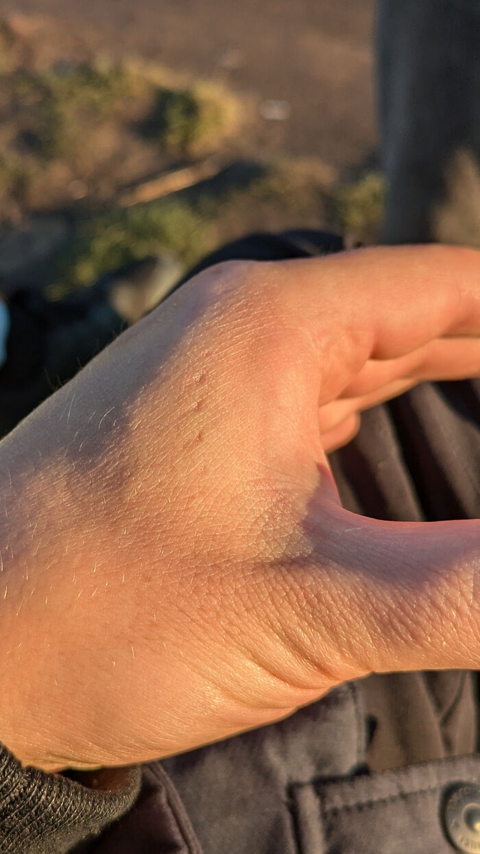 Bite Marks Showed Up 2 Years After Snake Bite On My Hand