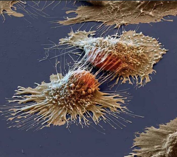 Cancer Cells Look Like a Zombie Apocalypse Under An Electron Microscope