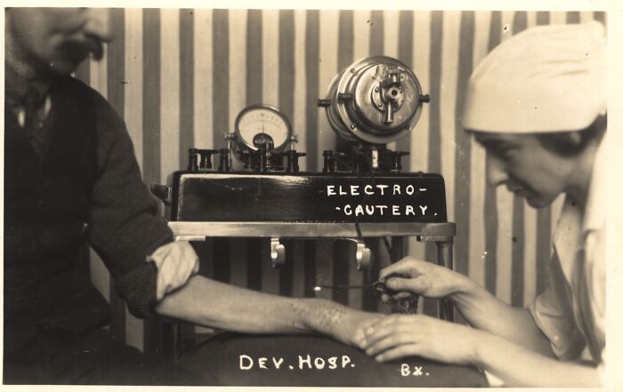 Burn Baby Burn: Electrocautery, 1934