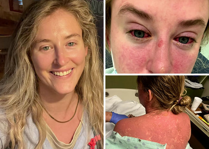 The Illness That Turned Her Into a Real-Life Zombie