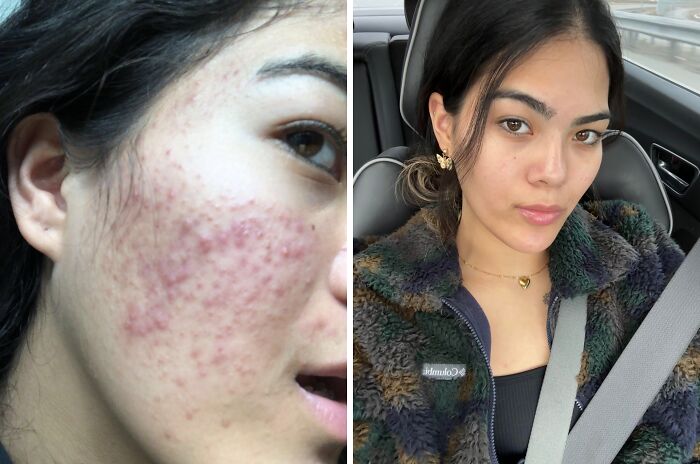 From Acne Nightmare To Loving My Skin Every Day