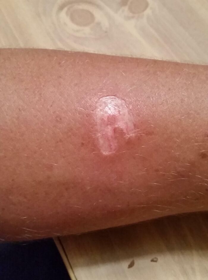 One Drunk 'Friend' Decided a Lighter Was a Great Way to Show Affection