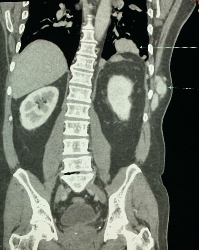 Spare Parts: Extra Organs