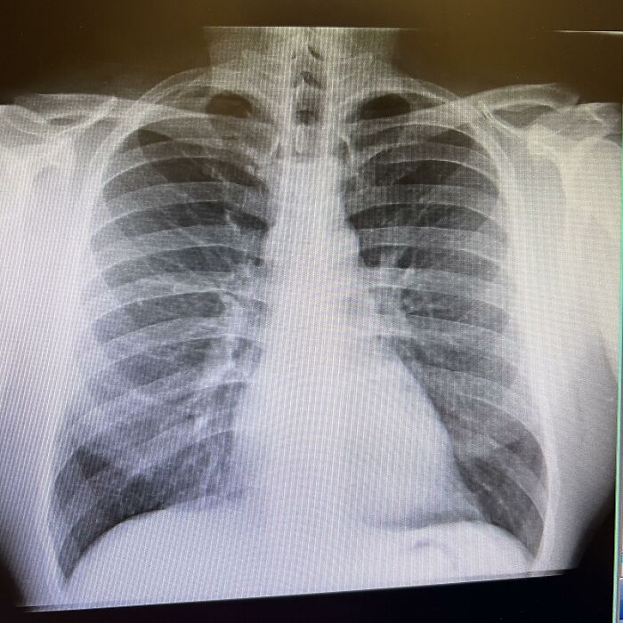 Lopsided Lungs? Yep, And It Works