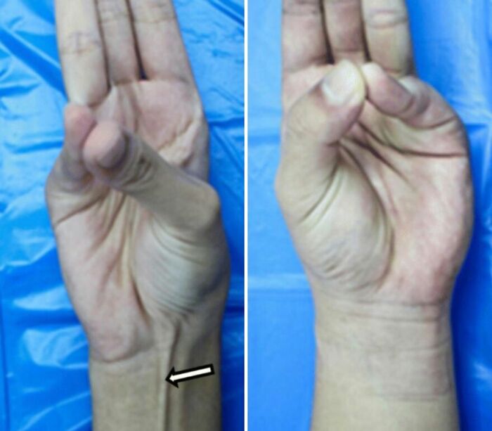Sometimes Your Forearm’s Missing a Muscle