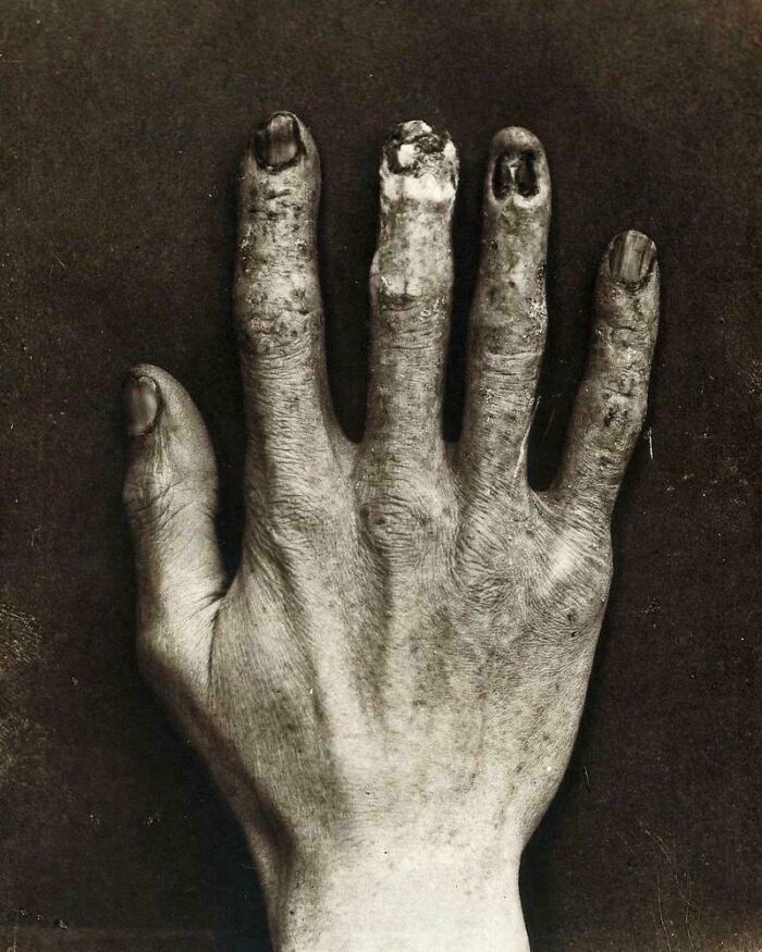An X-Ray Tech’s Hand From 1900 Shows What Radiation Can Do... Yikes!