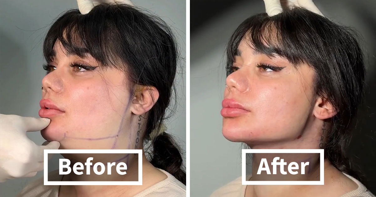 Wait Till You See These Jawline Transformations That Are Totally Mesmerizing (31 Pics)