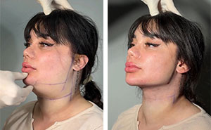Wait Till You See These Jawline Transformations That Are Totally Mesmerizing (31 Pics)