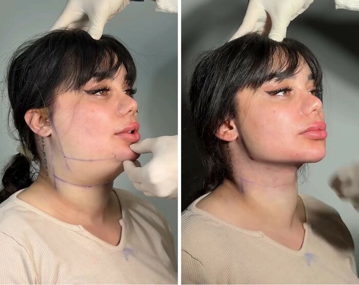 Wait Till You See These Jawline Transformations That Are Totally Mesmerizing (31 Pics)