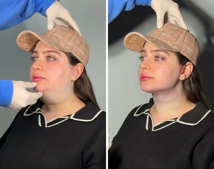 Wait Till You See These Jawline Transformations That Are Totally Mesmerizing (31 Pics)