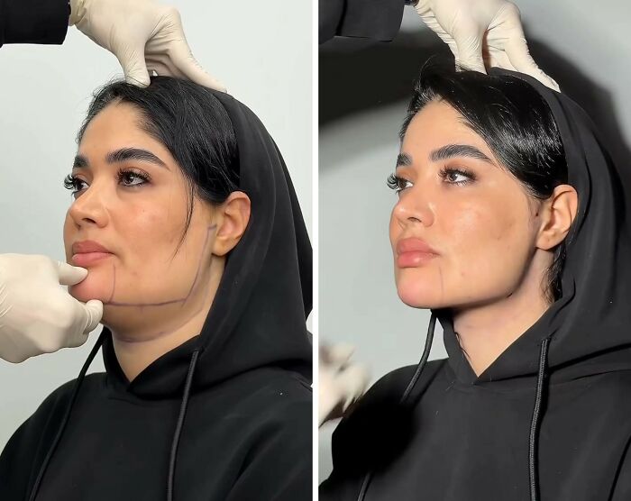 Wait Till You See These Jawline Transformations That Are Totally Mesmerizing (31 Pics)
