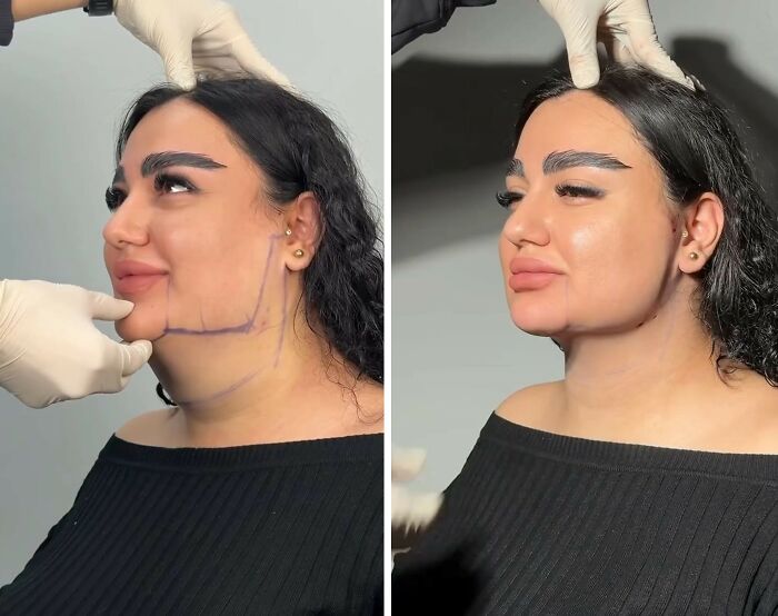 Wait Till You See These Jawline Transformations That Are Totally Mesmerizing (31 Pics)