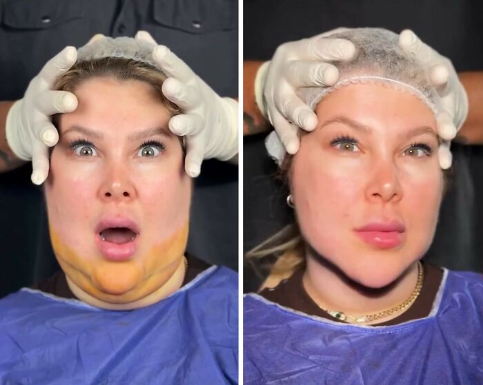Wait Till You See These Jawline Transformations That Are Totally Mesmerizing (31 Pics)