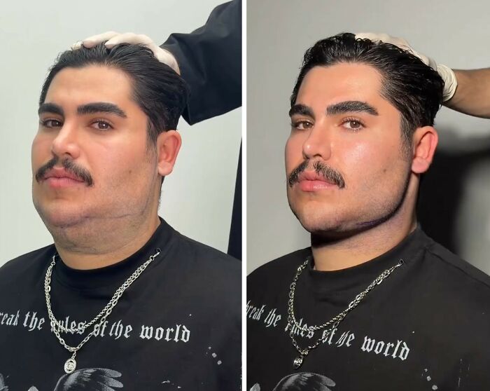 Wait Till You See These Jawline Transformations That Are Totally Mesmerizing (31 Pics)
