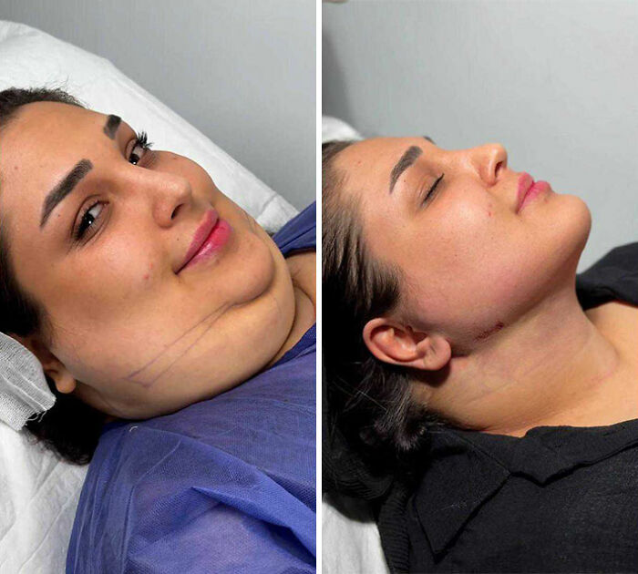 Wait Till You See These Jawline Transformations That Are Totally Mesmerizing (31 Pics)