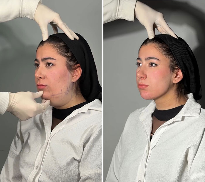 Wait Till You See These Jawline Transformations That Are Totally Mesmerizing (31 Pics)