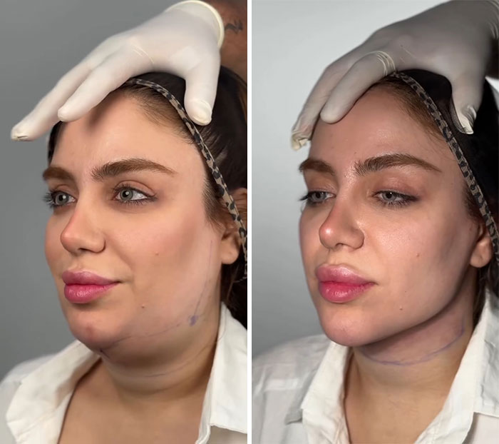 Wait Till You See These Jawline Transformations That Are Totally Mesmerizing (31 Pics)