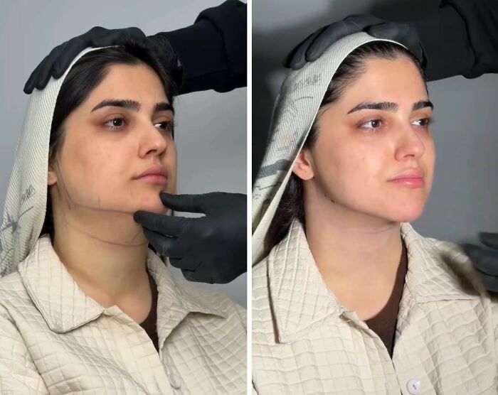 Wait Till You See These Jawline Transformations That Are Totally Mesmerizing (31 Pics)