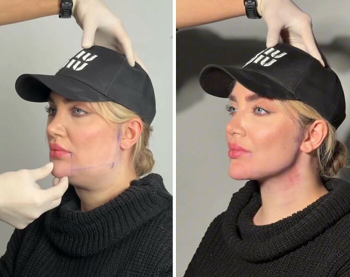 Wait Till You See These Jawline Transformations That Are Totally Mesmerizing (31 Pics)