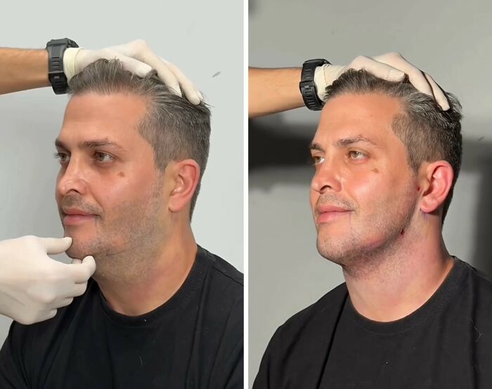 Wait Till You See These Jawline Transformations That Are Totally Mesmerizing (31 Pics)