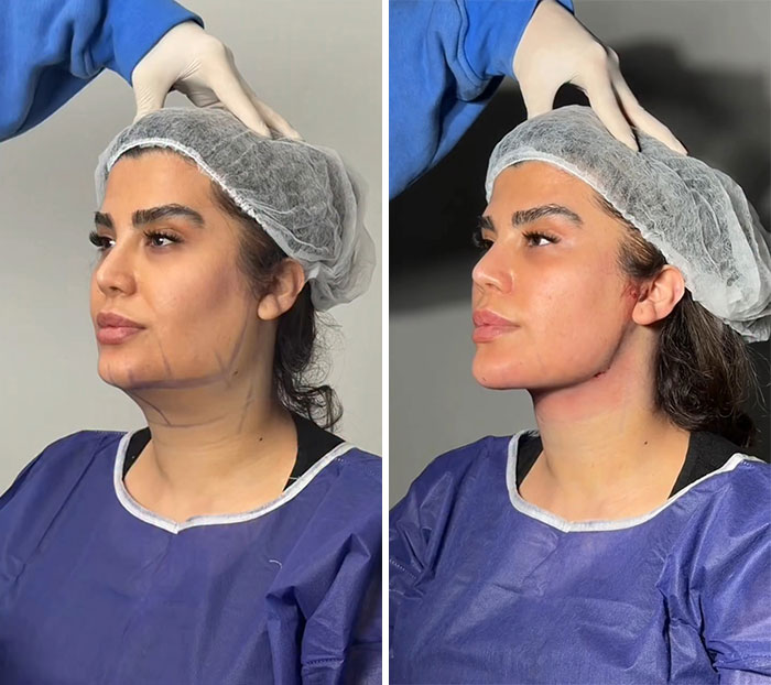Wait Till You See These Jawline Transformations That Are Totally Mesmerizing (31 Pics)