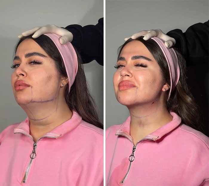 Wait Till You See These Jawline Transformations That Are Totally Mesmerizing (31 Pics)