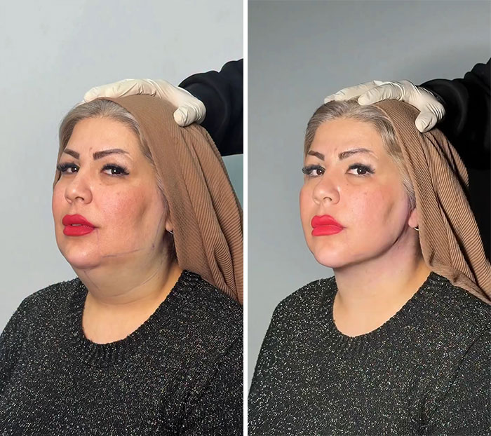 Wait Till You See These Jawline Transformations That Are Totally Mesmerizing (31 Pics)