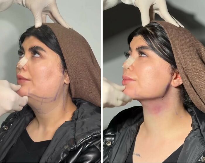 Wait Till You See These Jawline Transformations That Are Totally Mesmerizing (31 Pics)