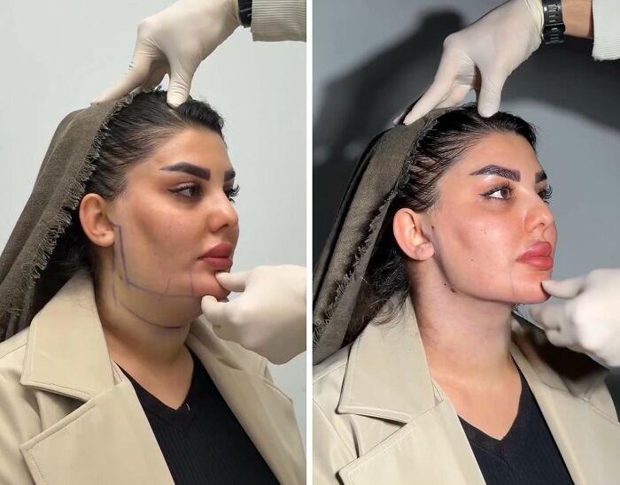 Wait Till You See These Jawline Transformations That Are Totally Mesmerizing (31 Pics)