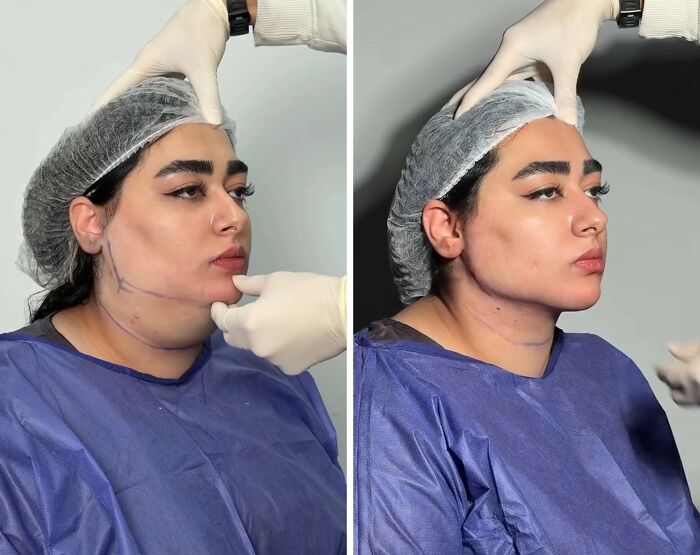 Wait Till You See These Jawline Transformations That Are Totally Mesmerizing (31 Pics)