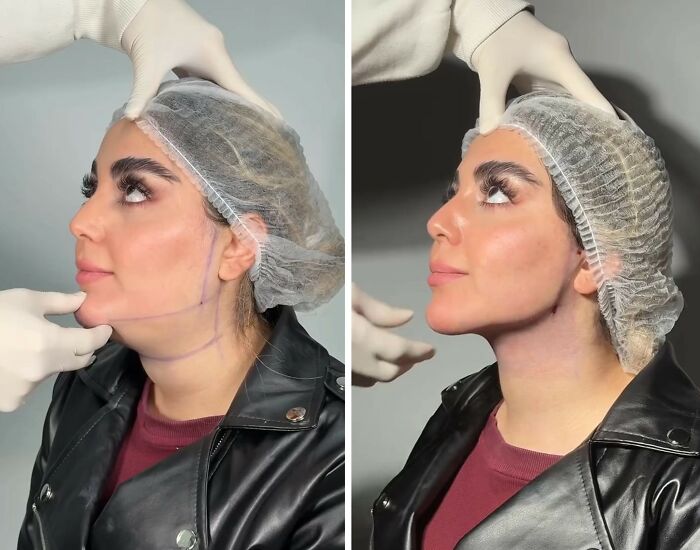 Wait Till You See These Jawline Transformations That Are Totally Mesmerizing (31 Pics)