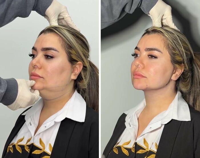 Wait Till You See These Jawline Transformations That Are Totally Mesmerizing (31 Pics)