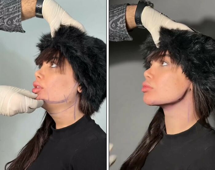 Wait Till You See These Jawline Transformations That Are Totally Mesmerizing (31 Pics)