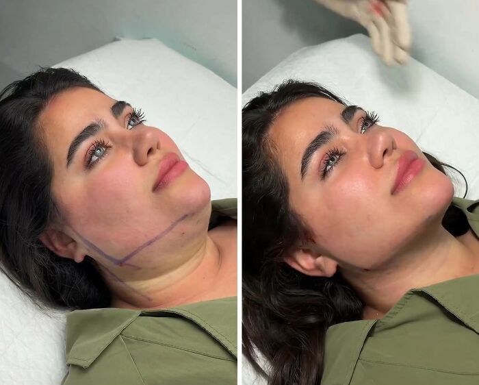 Wait Till You See These Jawline Transformations That Are Totally Mesmerizing (31 Pics)