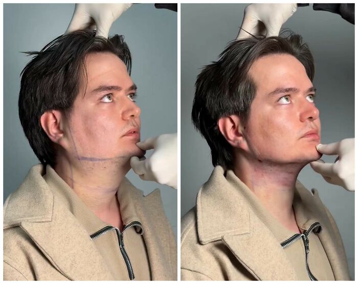 Wait Till You See These Jawline Transformations That Are Totally Mesmerizing (31 Pics)