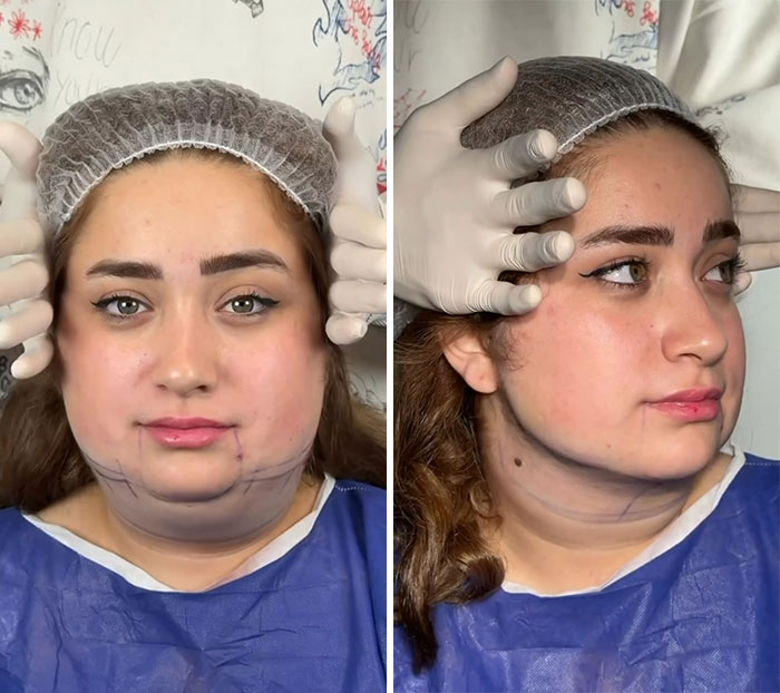 Wait Till You See These Jawline Transformations That Are Totally Mesmerizing (31 Pics)