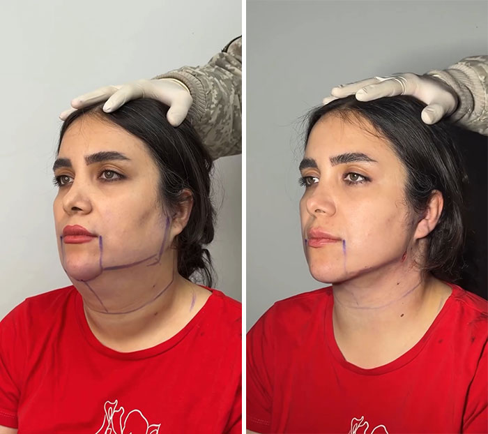 Wait Till You See These Jawline Transformations That Are Totally Mesmerizing (31 Pics)
