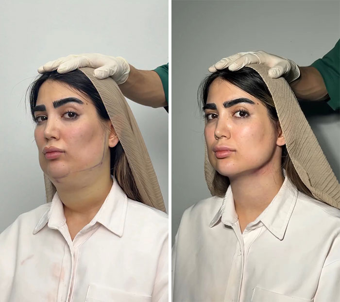 Wait Till You See These Jawline Transformations That Are Totally Mesmerizing (31 Pics)