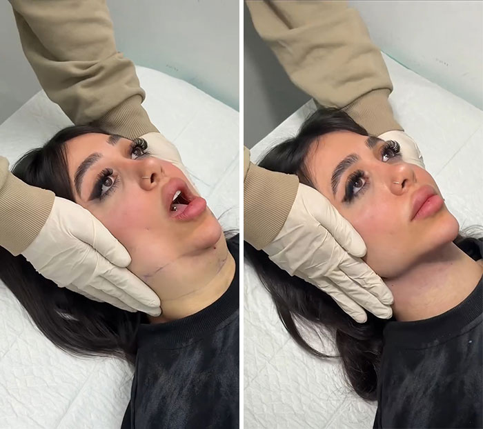 Wait Till You See These Jawline Transformations That Are Totally Mesmerizing (31 Pics)