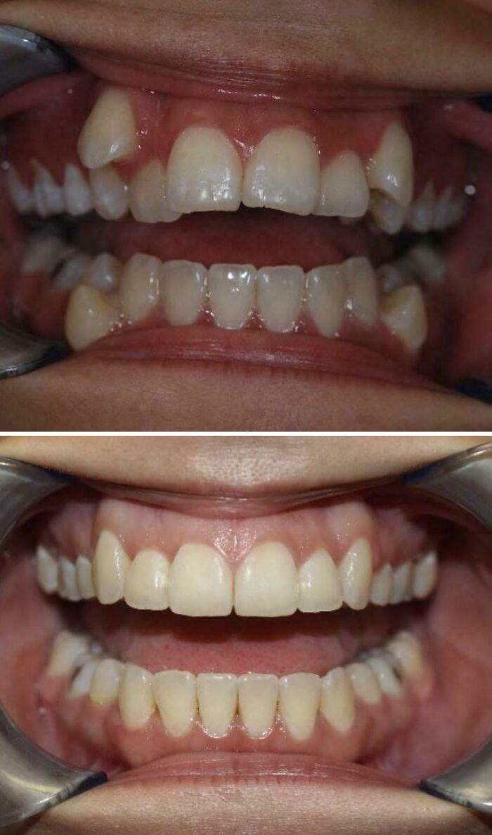 Teeth Transformation: Before Braces vs. After Braces (Smile Level: Expert)