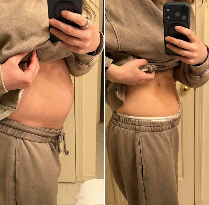 Before and After Ovarian Cyst Removal: A Real-Life Transformation