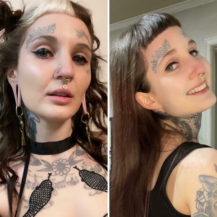 Ear Reconstruction: Before vs. Almost 3 Years Later—What a Change!