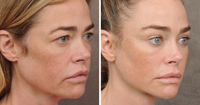 15 Celebs Who Didn’t Mind Showing Off Their Plastic Surgery Wins