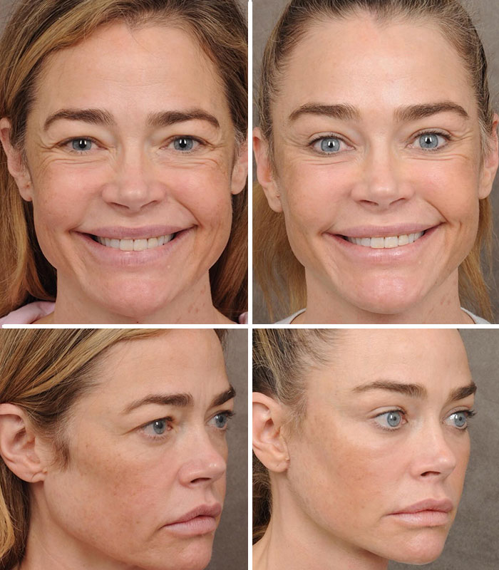 Denise Richards - The Full Face Refresh