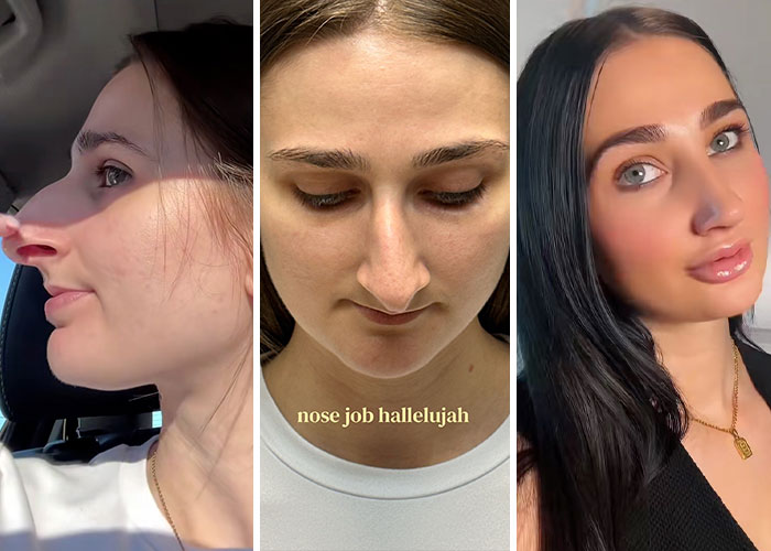Devyn Aiken - Nose Job for a Fresh Start