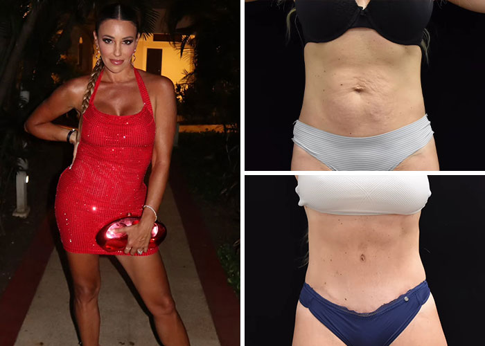 Danielle Cabral - Tummy Tuck Triumph
