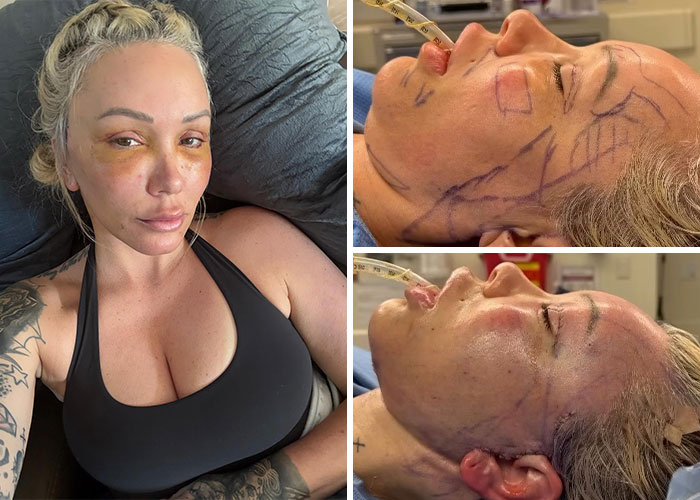 Bunnie Xo - Facelift Glow-Up