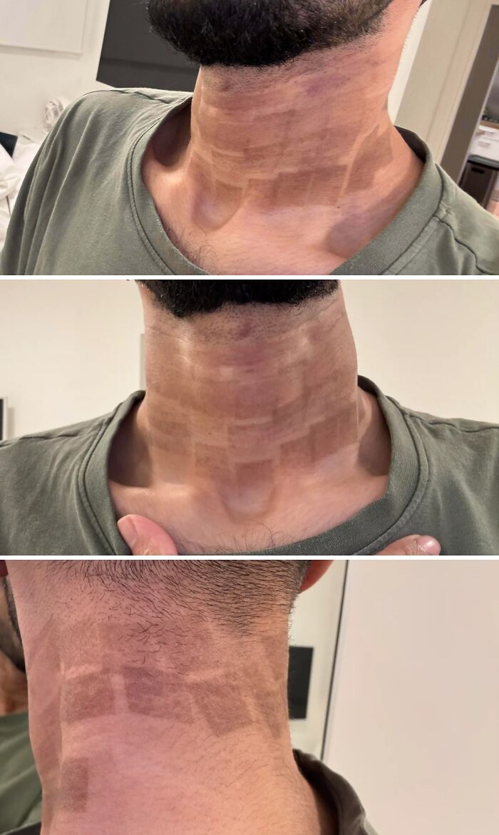 Laser Treatment Went TOTALLY Wrong