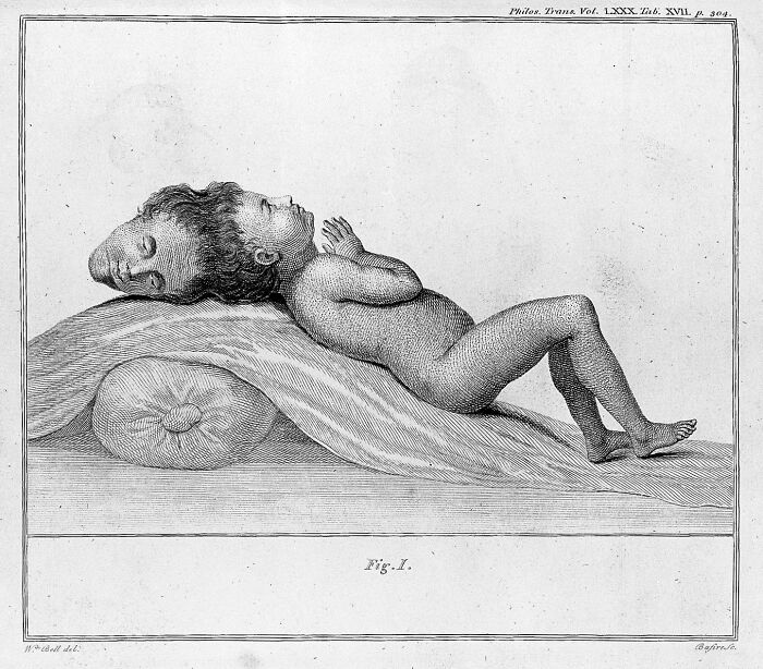 A Boy Born With Two Heads, One Upside Down, Could Surprisingly Hear Both Brains