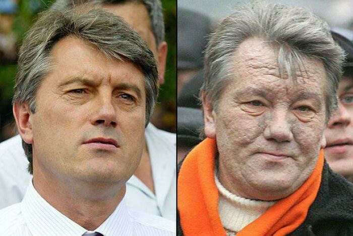Ukrainian Candidate Got Poisoned To Disfigure His Face In 2004, But Still Won The Election